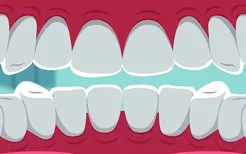 用小苏打刷牙牙齿会变白吗 经常用小苏打刷牙有什么危害