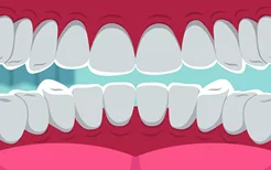 洗牙可以让牙齿变白吗 洗牙的好处有哪些