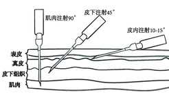 皮下皮内肌肉注射角度及部位图片