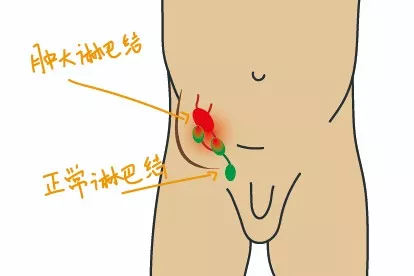 淋巴结肿大图片