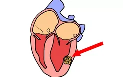 心脏横纹肌瘤图片