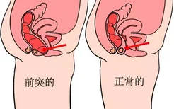 直肠前突和正常直肠图片
