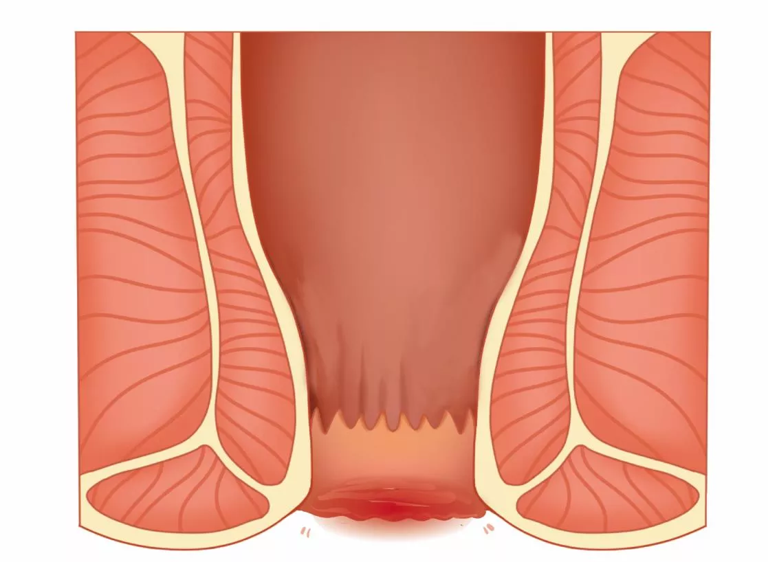 肛门肿胀突出图片