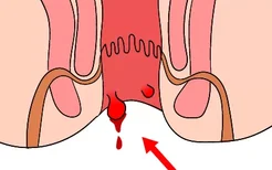 肛痔图片和症状图片