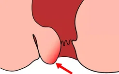肛门内痔疮脱出图片