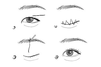 双眼皮埋线过程图
