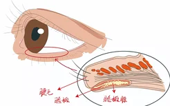 正常睑板腺开口图片