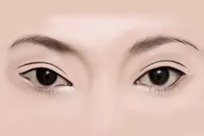 韩式双眼皮恢复图