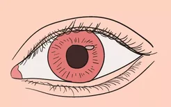 眼部白化病的早期症状图片