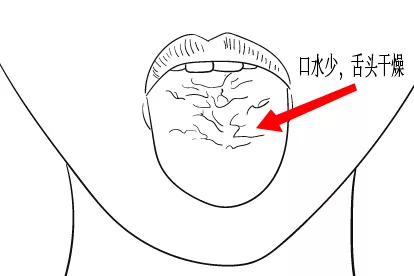 血糖高舌头图片