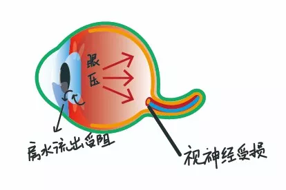 眼压高图片