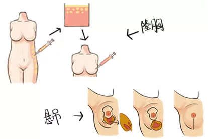 悬吊隆胸手术图片