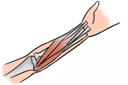伸肌总腱炎部位图