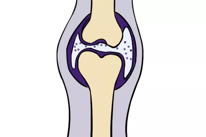 膝盖滑膜炎肿胀图