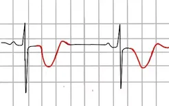 t波倒置心电图图片