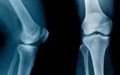 膝盖x光图片