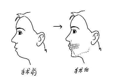 下颌后缩手术图