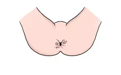 肛周鳞状细胞癌的图片