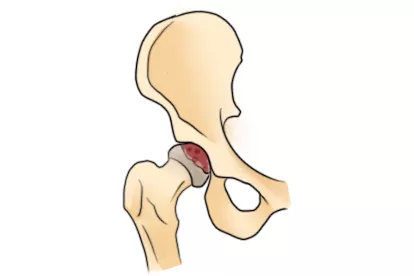 股骨头坏死图片