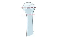 肱骨外科颈解剖示意图