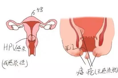 痔疮hpv感染区分图