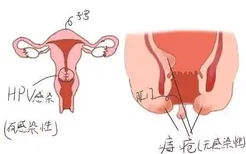 痔疮和hpv感染怎么区分