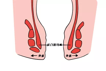 肛门括约肌松弛图