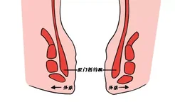 肛门括约肌松弛图片