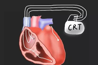 三腔心脏起搏器图片