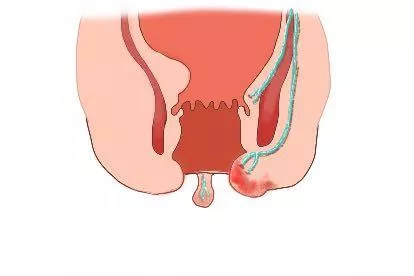 痔疮静脉曲张图片