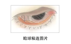 睑球粘连图片