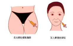 大腿脂肪填充脸部图片