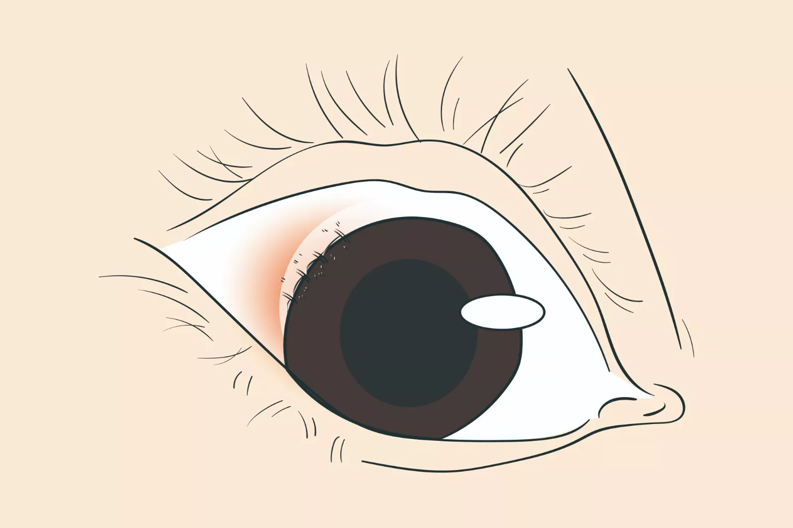 眼角膜缝合拆线图