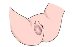 肛周脓肿手术后水肿图片