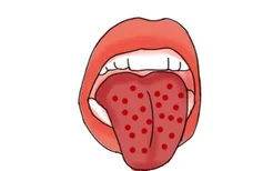 血小板低舌头出血点图片