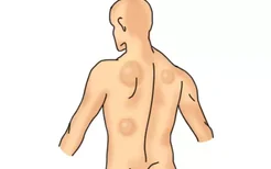 背部淋巴瘤图片
