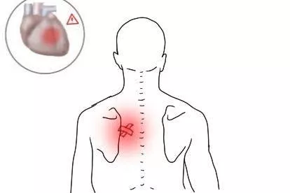 心脏病反射后背疼位置图