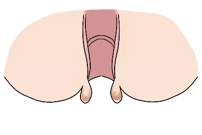 肛门急性血栓图片
