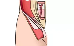 大腿内侧腹股沟位置图