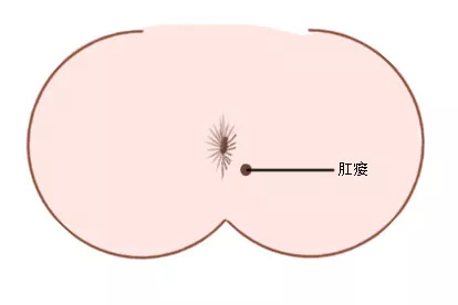 肛瘘恢复后有洞图