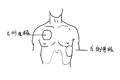 心肺复苏电极贴片位置图