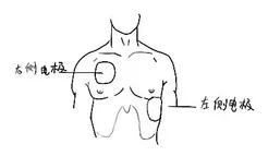 心肺复苏电极贴片位置图示意图