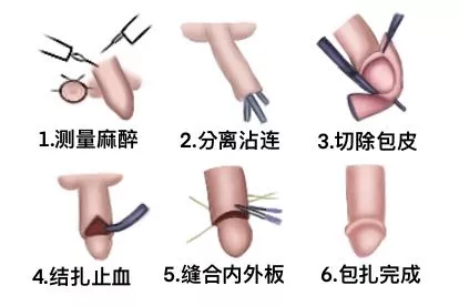 成年男环切过程图