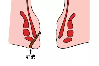 肛门旁边有个洞图