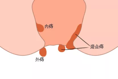 痔疮结构图