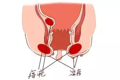 痔疮和湿疹区别图