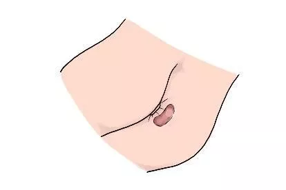 肛周囊肿术后图片