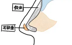 假体加耳软骨隆鼻图片