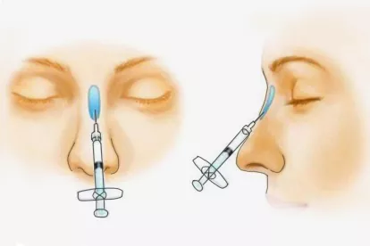 玻尿酸隆鼻注射图