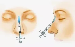 玻尿酸隆鼻注射位置图